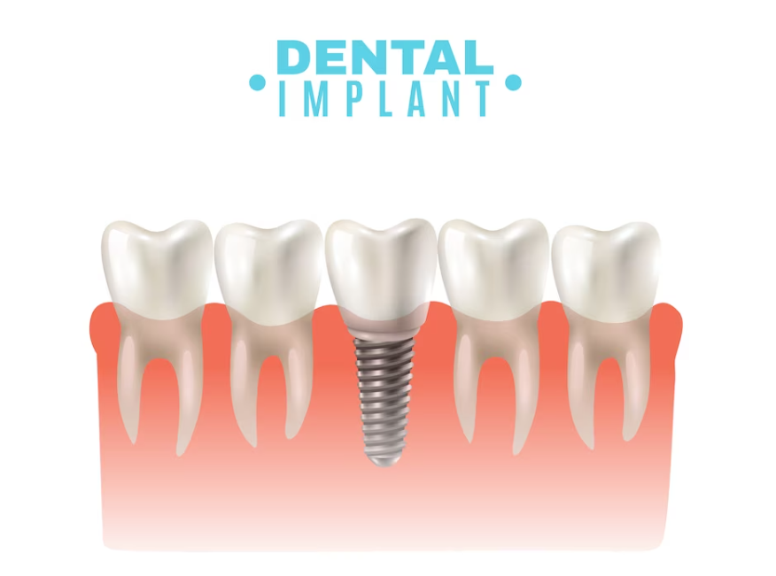 Unveiling the Smile Saviors: The Benefits of Dental Implants