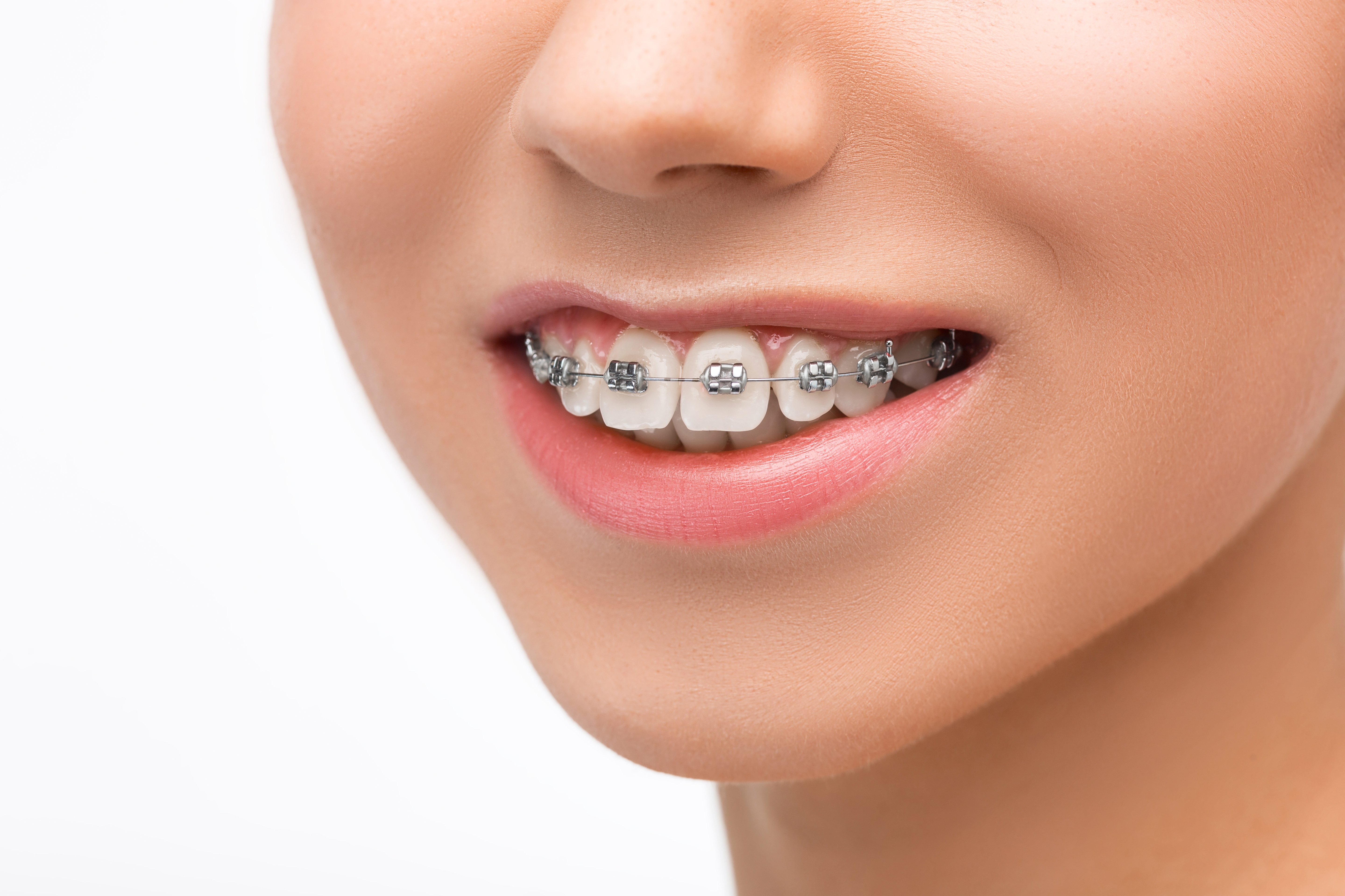 Understanding Metal Braces for Orthodontic Treatment in Delhi, India