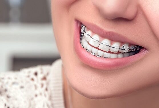 How to Choose the Right Braces For Yourself?