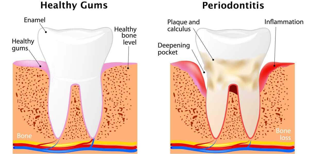 Gum dentistry (periodontics)