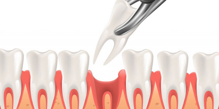 Tooth extractions