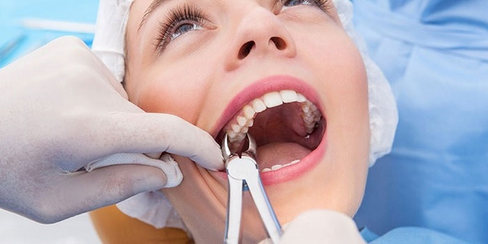 Wisdom teeth extractions