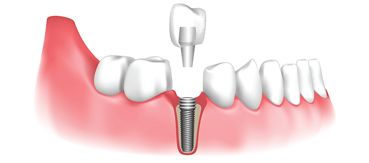 Best Dental Implant Clinic In Delhi