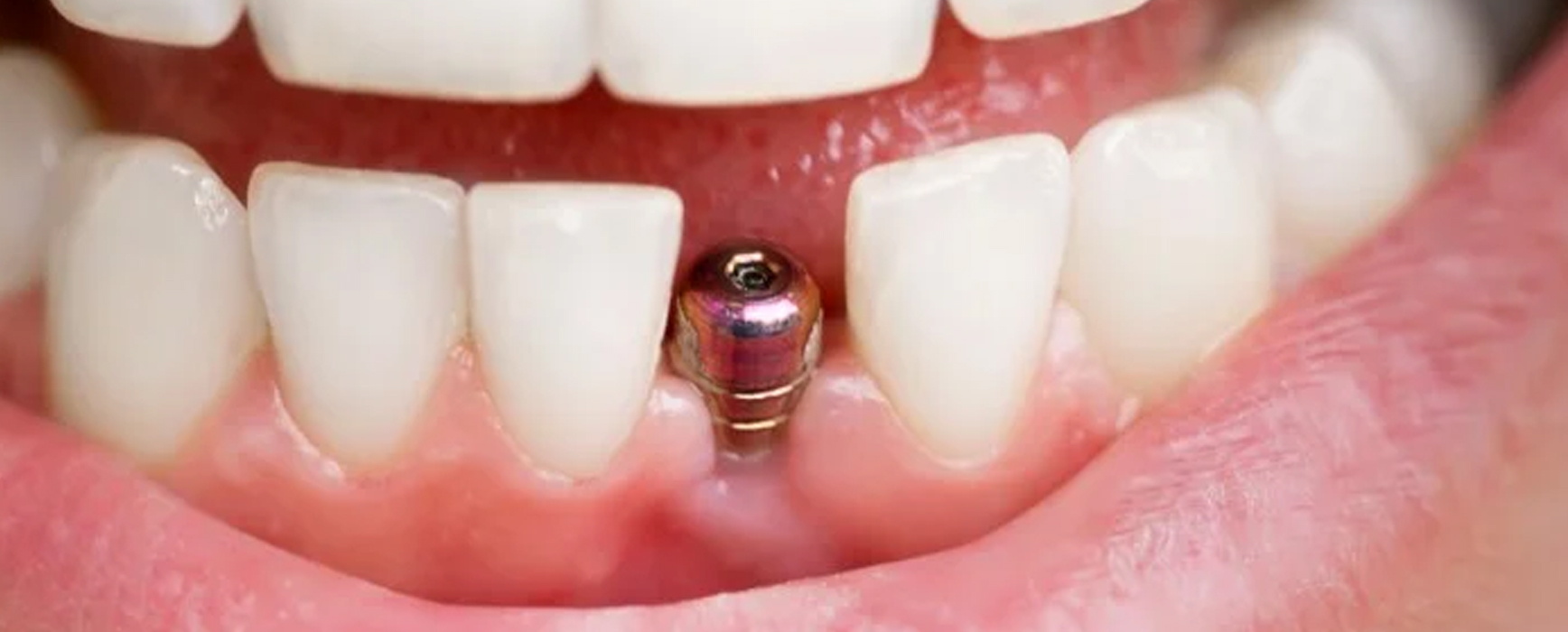 Single tooth implants