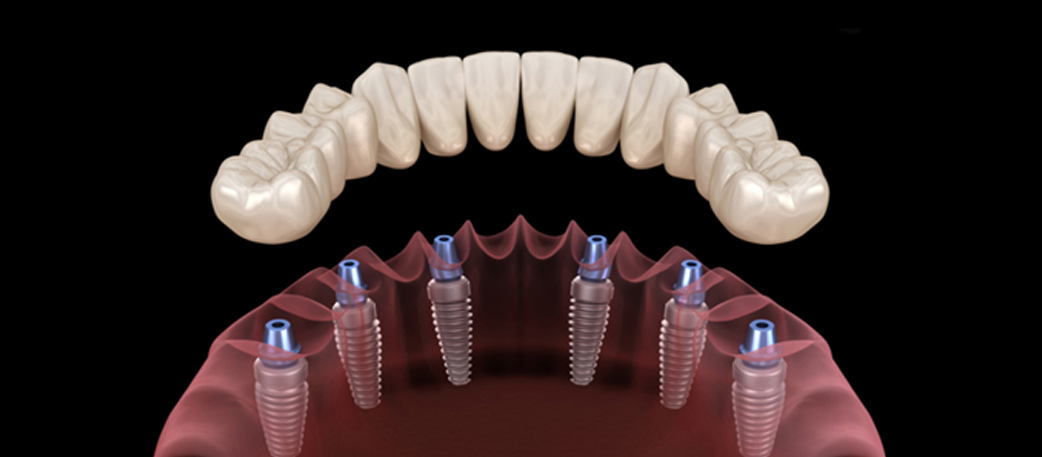 Full Mouth Dental Implants