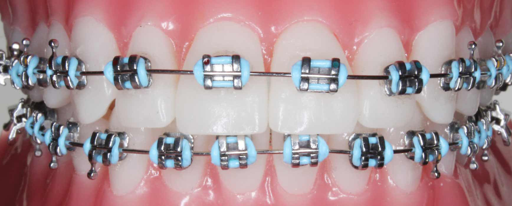 Metal Braces