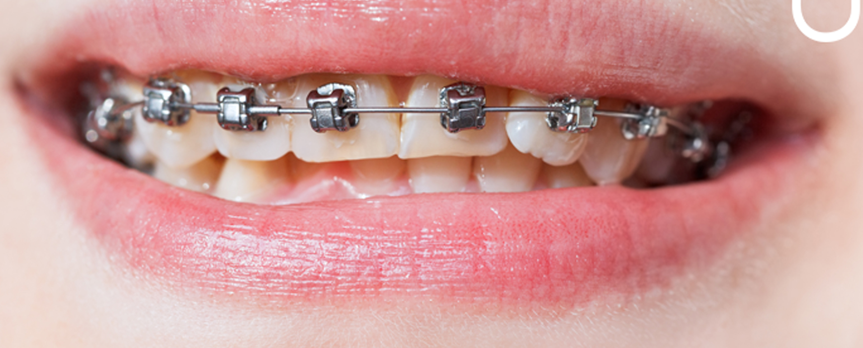 Self Ligating Damon Braces