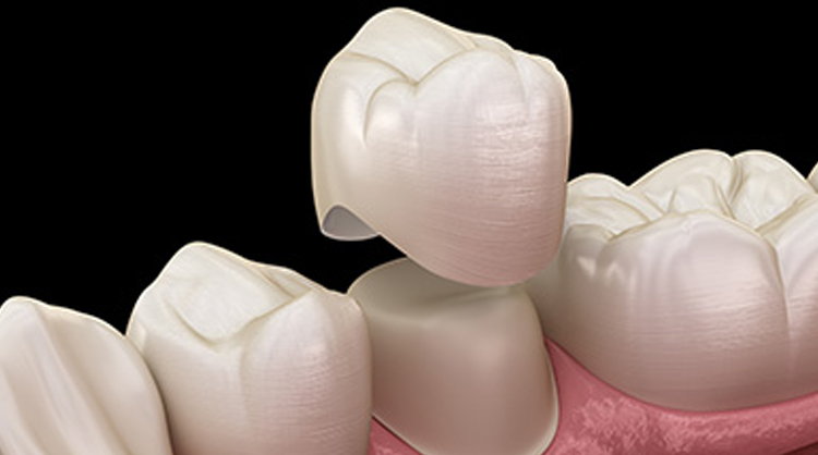 Ceramic crowns