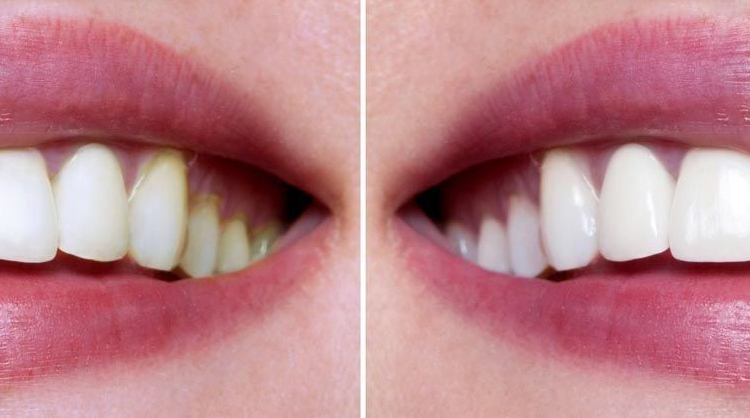 Enamel Recontouring