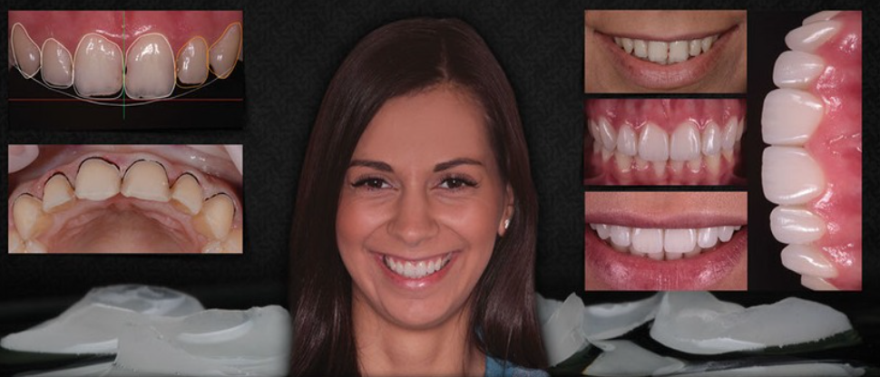 Smile Design - Invisalign Treatment in Delhi